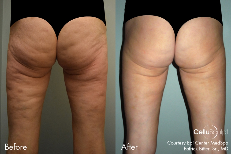CelluSculpt-before-after-1