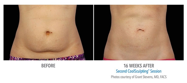 CoolSculpting-Before-and-After1