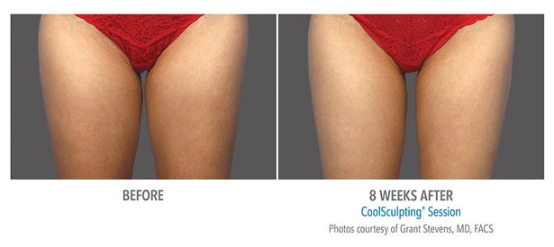 CoolSculpting-Before-and-After4