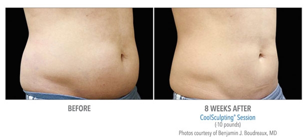 CoolSculpting-Before-and-After5
