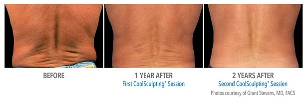 CoolSculpting-Before-and-After6
