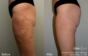 CelluSculpt-before-after-2