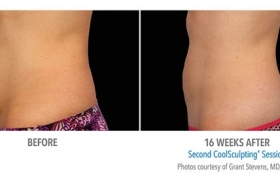 CoolSculpting-Before-and-After2