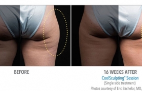 CoolSculpting-Before-and-After3
