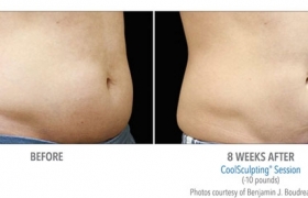 CoolSculpting-Before-and-After5
