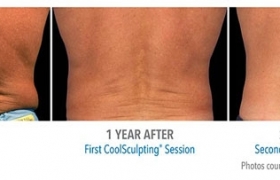 CoolSculpting-Before-and-After6