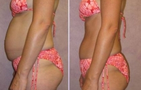 HCG-Diet-before-after