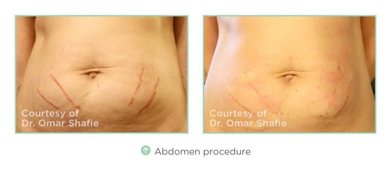 abdomen-procedure