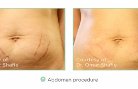 abdomen-procedure