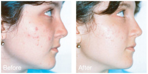 Blue Light Acne Treatment Before and After Photo