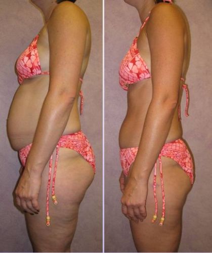 HCG Diet before after