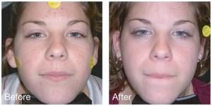 Laser Acne before after
