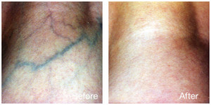 Laser Leg Vein before/after
