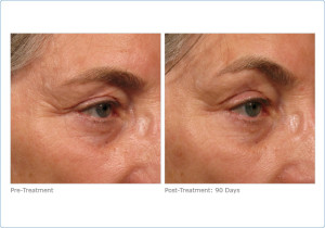 Skin Tightening with Ultherapy in San Francisco | Epi Center | ultherapy_brow_2-3