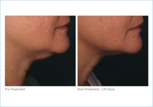 Skin Tightening with Ultherapy in San Francisco | Epi Center | ultherapy_lower_face_2-1