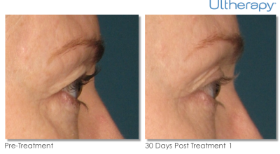 thumb_ultherapy-000k-004y_0day-30day-1tx_beforeafter_brow