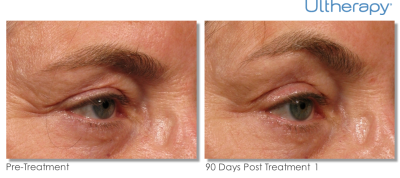thumb_ultherapy-005a-018y_0day-90day-1tx_beforeafter_brow