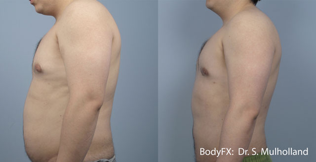 Body FX before and after