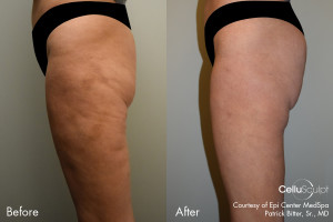 CelluSculpt-before-after-2
