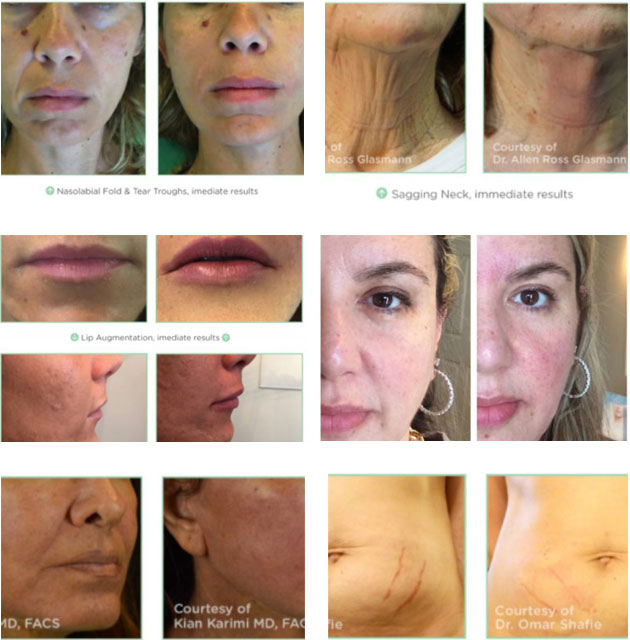PDO Thread Lift in San Francisco | Novathreads Face Lift | EpiCenter | Before and After