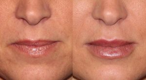 Juvederm Vobella before and after