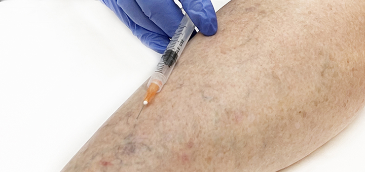 Sclerotherapy (spider Veins), Sima Medical & Cosmetic Clinic