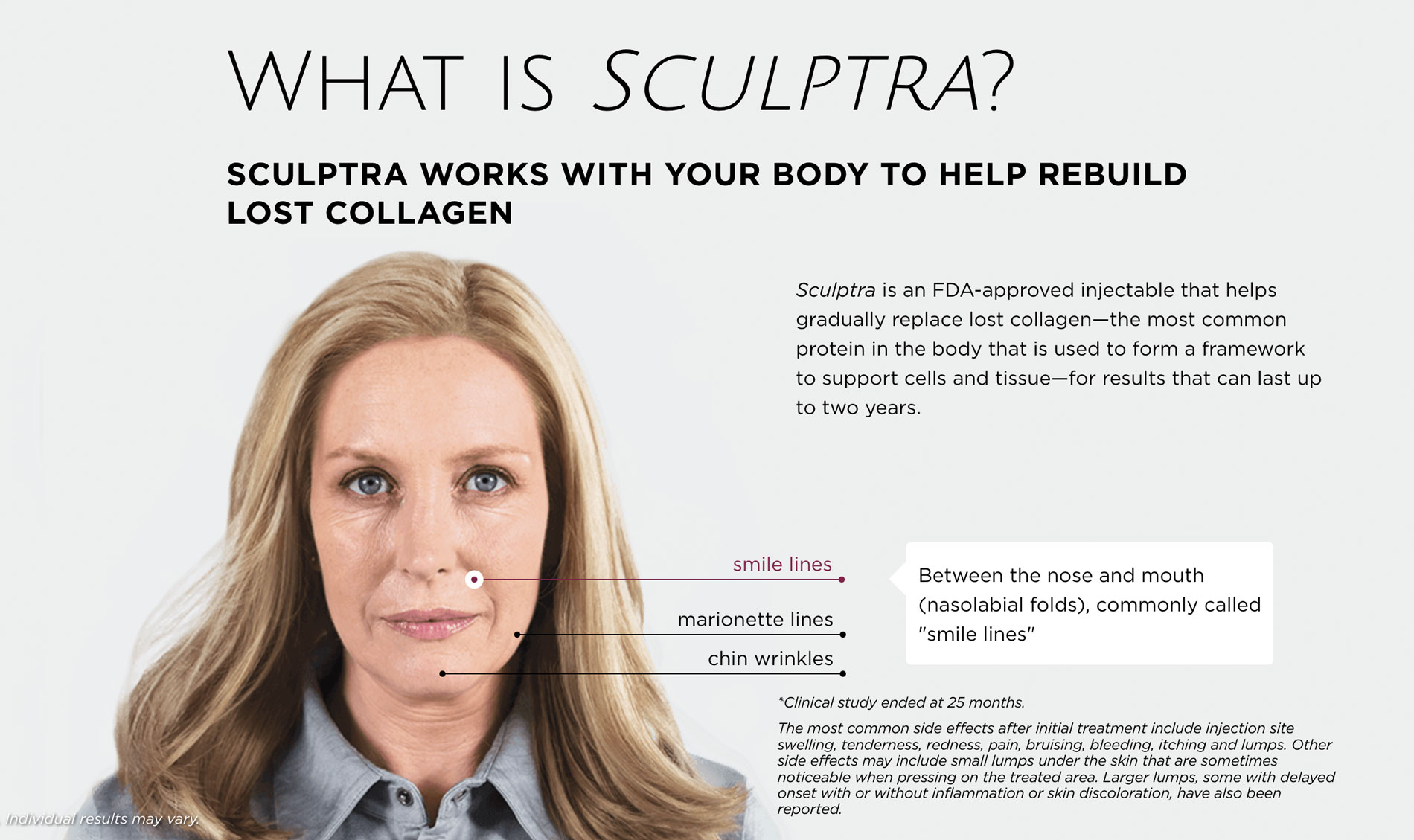 What is Sculptra