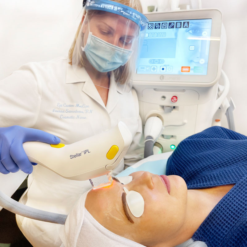 Photofacial Treatment