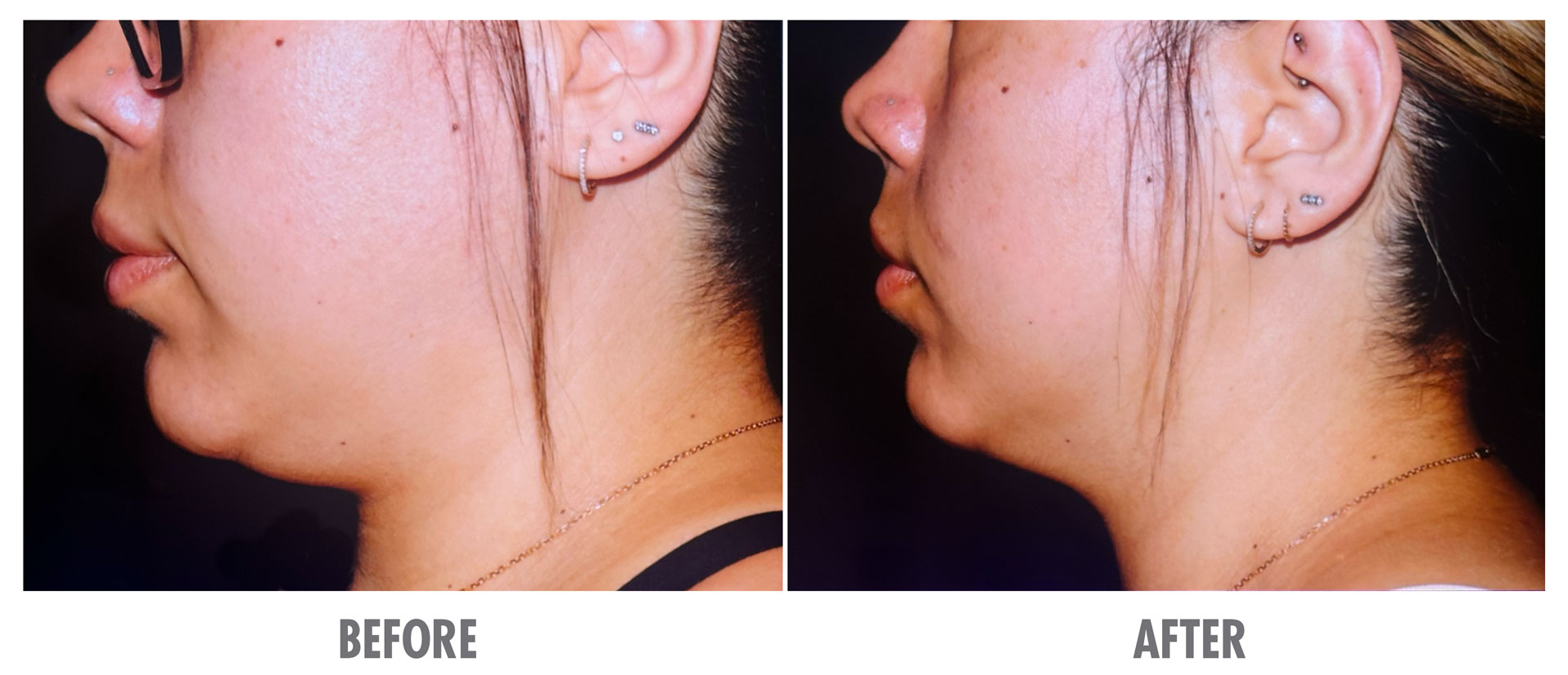 Before and After Coolsculpting Elite for Neck